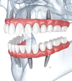 All-on-4 Implants