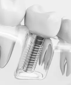 Invisalign