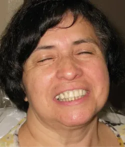 Before All-on-4 treatment