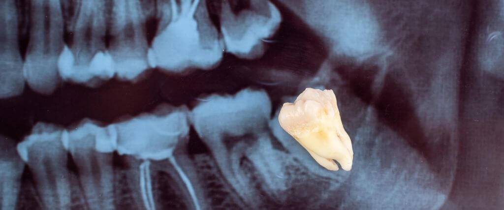 Dental x-ray image of a wisdom tooth