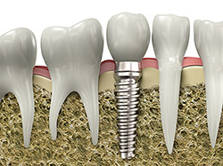 implant model