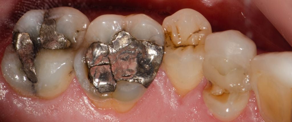 Broken amalgam fillings with mercury