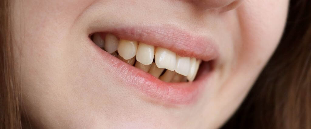 Woman with malocclusion bite alignment issues
